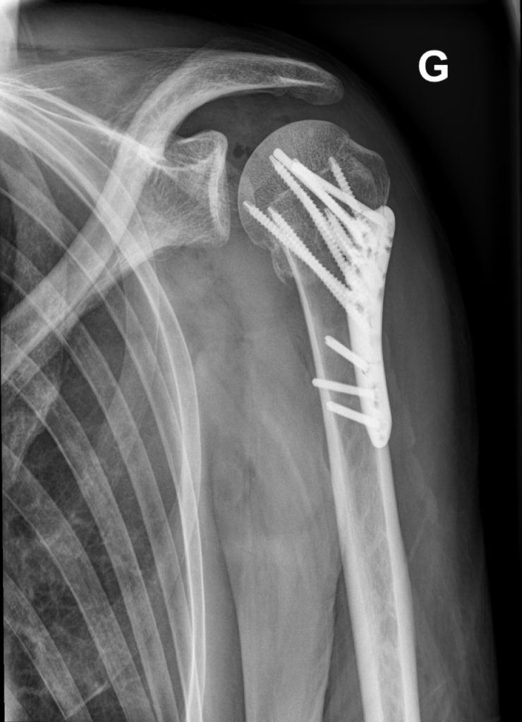 X-Ray of shoulder showing metal plate in arm.